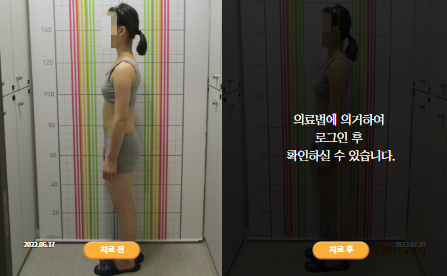 바로선치료 [10대 여성] 안면비대칭