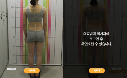 바로선치료 [10대 여성] 턱관절