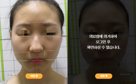 바로선치료 [10대 여성] 안면비대칭