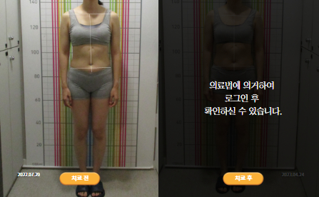 바로선치료 [30대 여성] 턱관절