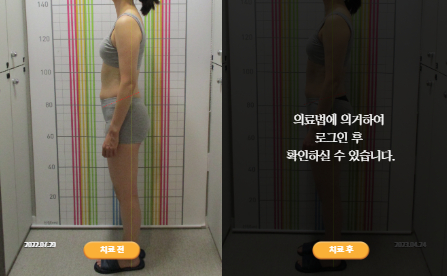바로선치료 [30대 여성] 안면비대칭
