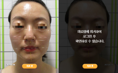 바로선치료 [30대 여성] 안면비대칭