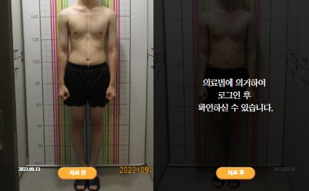 바로선치료 [20대 남성] 턱관절