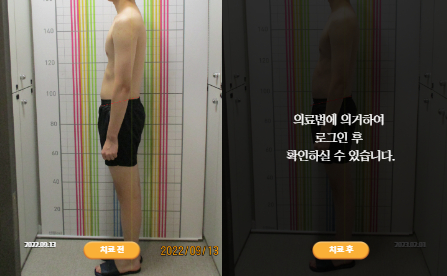 바로선치료 [20대 남성] 턱관절