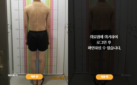 바로선치료 [20대 남성] 턱관절