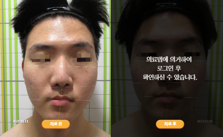 바로선치료 [20대 남성] 턱관절