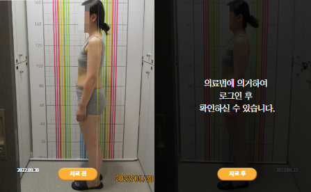 바로선치료 [20대 여성] 턱관절