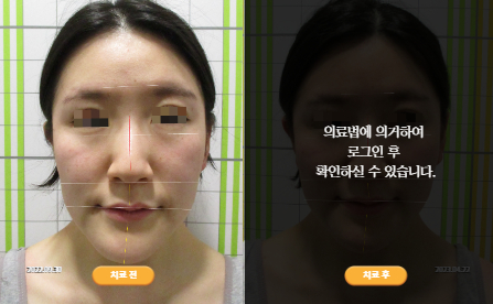 바로선치료 [20대 여성] 턱관절