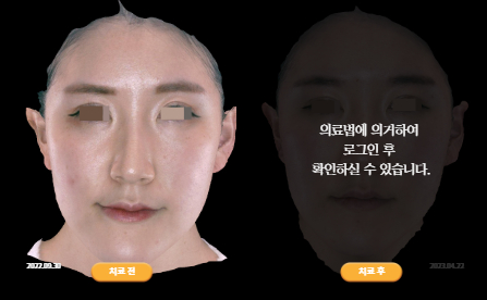 바로선치료 [20대 여성] 턱관절