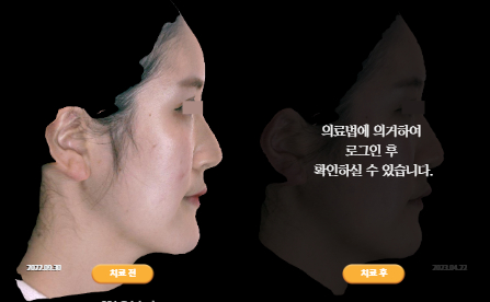 바로선치료 [20대 여성] 안면비대칭