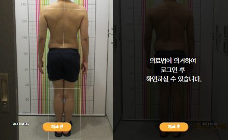 바로선치료 [20대 남성] 안면비대칭