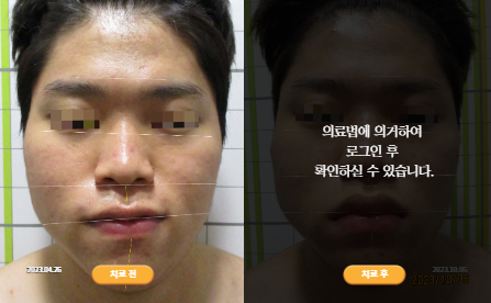 바로선치료 [20대 남성] 안면비대칭
