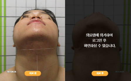 바로선치료 [20대 남성] 안면비대칭