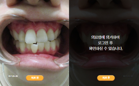 바로선치료 [20대 여성] 턱관절