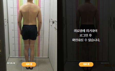 바로선치료 [20대 남성] 안면비대칭