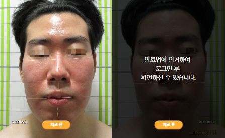 바로선치료 [20대 남성] 안면비대칭