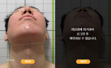 바로선치료 [20대 남성] 턱관절