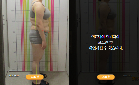 바로선치료 [20대 여성] 안면비대칭