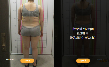 바로선치료 [20대 여성] 안면비대칭