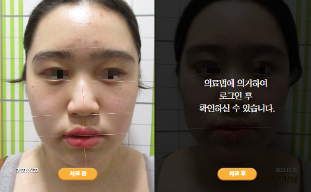 바로선치료 [20대 여성] 턱관절
