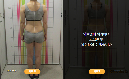 바로선치료 [40대 여성] 안면비대칭