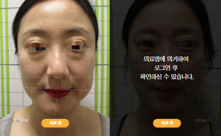 바로선치료 [40대 여성] 안면비대칭