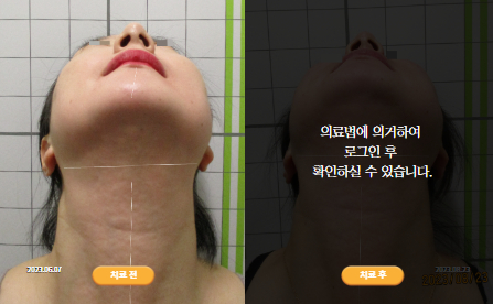 바로선치료 [40대 여성] 안면비대칭