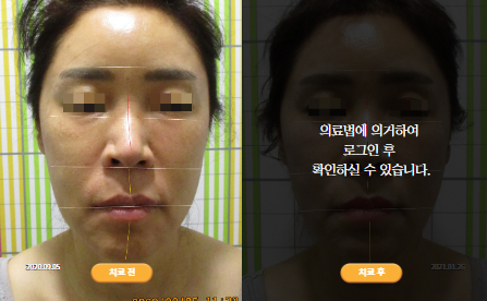 바로선치료 [50대 여성] 안면비대칭