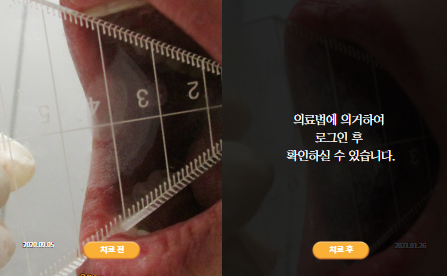 바로선치료 [50대 여성] 턱관절