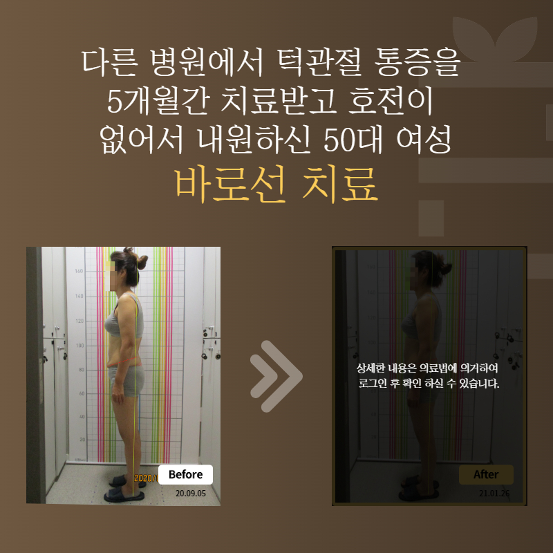 다른 병원에서 턱관절 통증을 5개월간 치료받고 호전이 없어서 내원하신 50대 여성 바로선치료