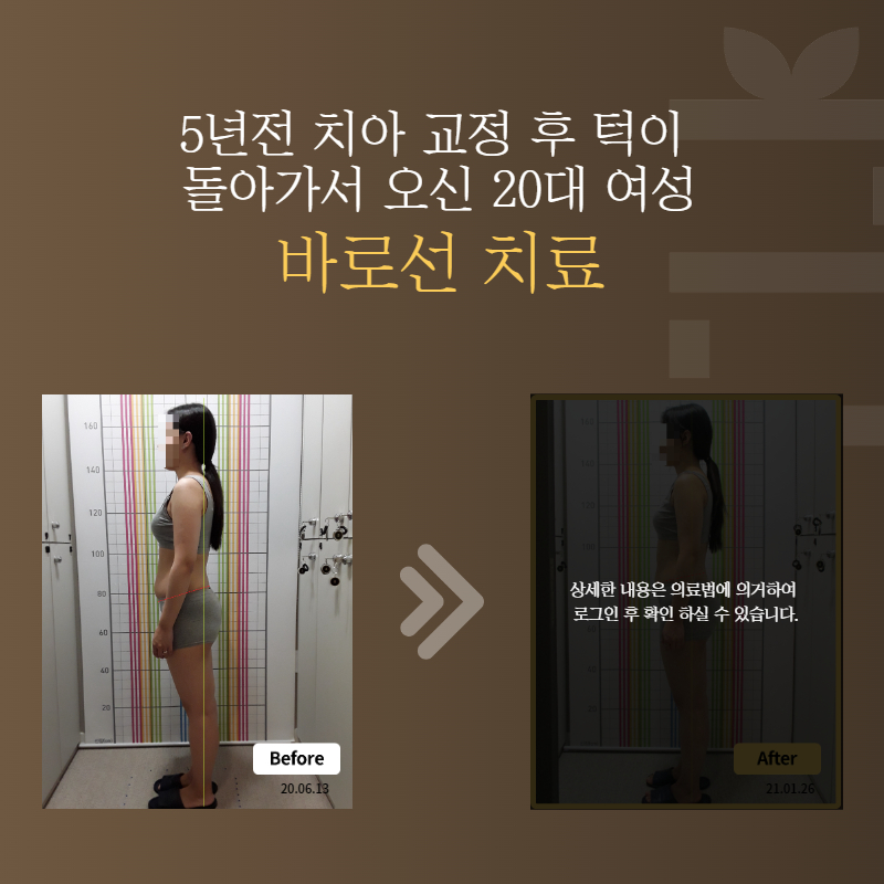 5년전 치아 교정 후 턱이 돌아가서 오신 20대 여성 바로선치료