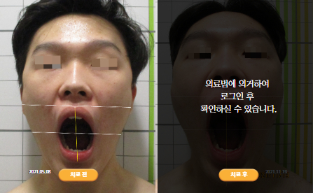 바로선치료 [20대 남성] 턱관절