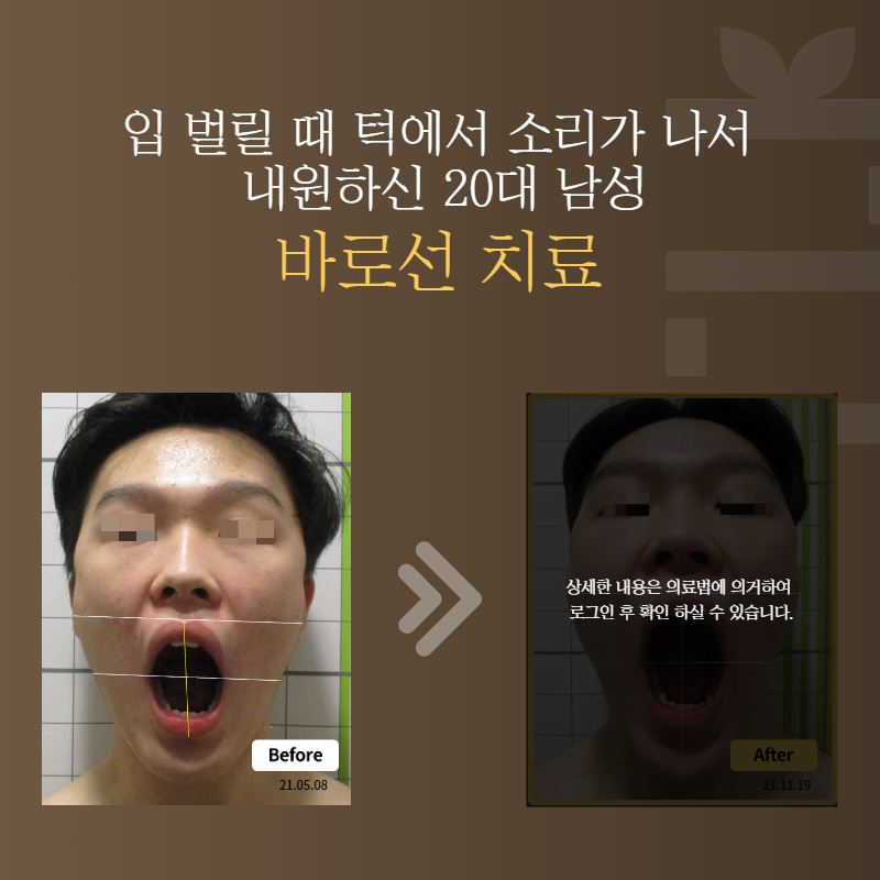 입 벌릴 때 턱에서 소리가 나서 내원하신 20대 남성 바로선치료