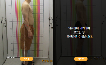 바로선치료 [30대 남성] 안면비대칭