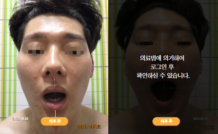 바로선치료 [30대 남성] 턱관절