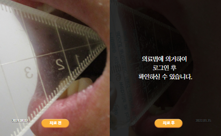 바로선치료 [30대 남성] 턱관절