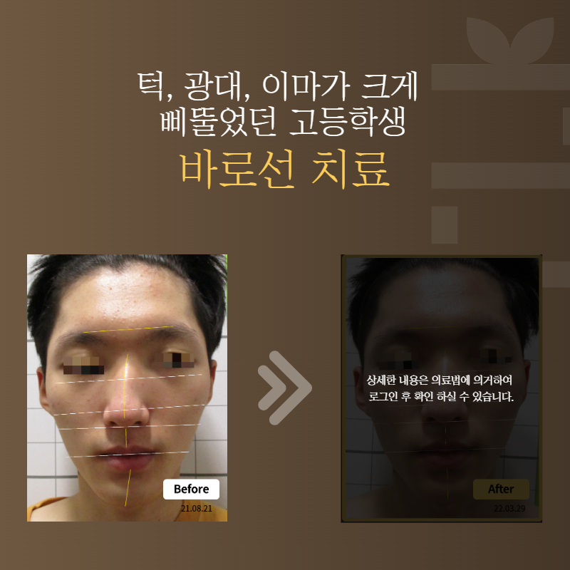 턱, 광대, 이마가 크게 삐뚤었던 고등학생 바로선치료