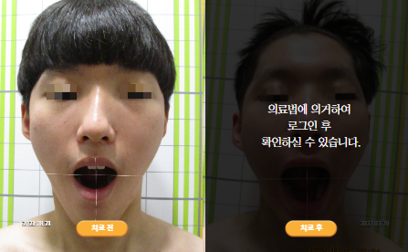 바로선치료 [10대 남성] 턱관절