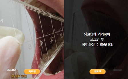 바로선치료 [10대 남성] 턱관절