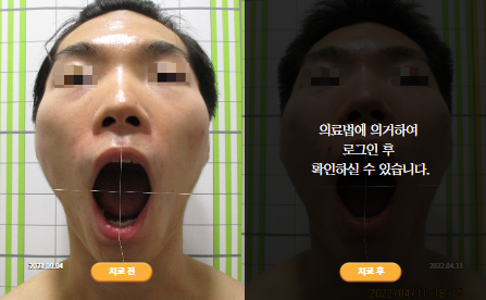 바로선치료 [20대 남성] 턱관절