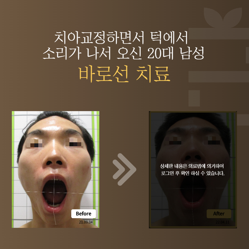 치아교정하면서 턱에서 소리가 나서 오신 20대 남성 바로선치료