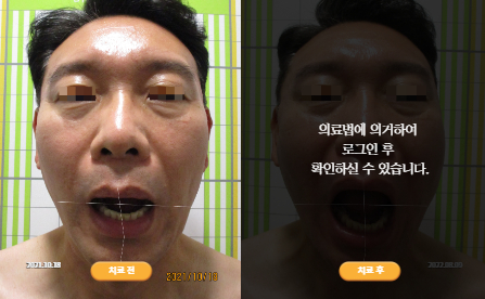 바로선치료 [50대 남성] 턱관절