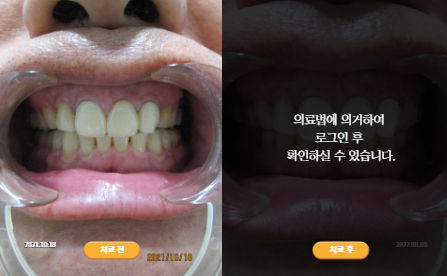 바로선치료 [50대 남성] 안면비대칭