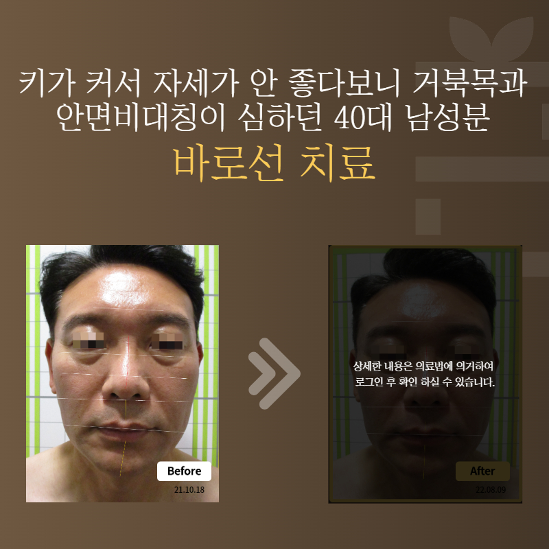키가 커서 자세가 안 좋다보니 거북목과 안면비대칭이 심하던 40대 남성분 바로선치료