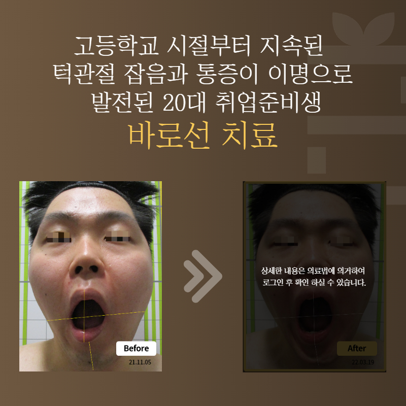 고등학교 시절부터 지속된 턱관절 잡음과 통증이 이명으로 발전된 20대 취업준비생 바로선치료