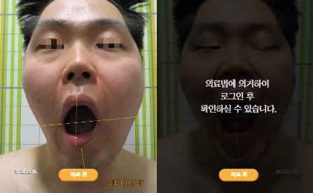 바로선치료 [20대 남성] 턱관절