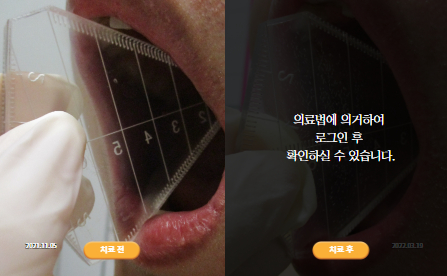 바로선치료 [20대 남성] 턱관절