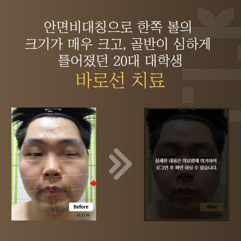 안면비대칭으로 한쪽 볼의 크기가 매우 크고, 골반이 심하게 틀어졌던 20대 대학생 바로선치료