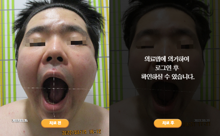 바로선치료 [20대 남성] 턱관절