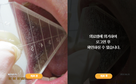 바로선치료 [20대 남성] 턱관절